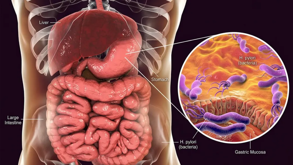 H. Pylori Kya Hai? — 9 Symptoms, Proven Test Aur Complete Ilaaj Guide h-pylori-kya-hai